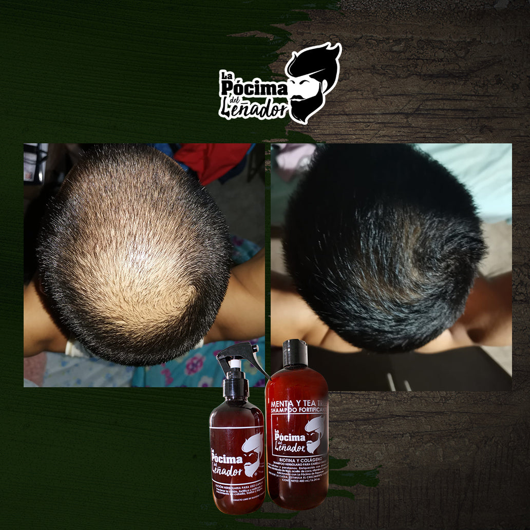 Tratamiento Intensivo Anti-grasa, cabello, barba y bigote